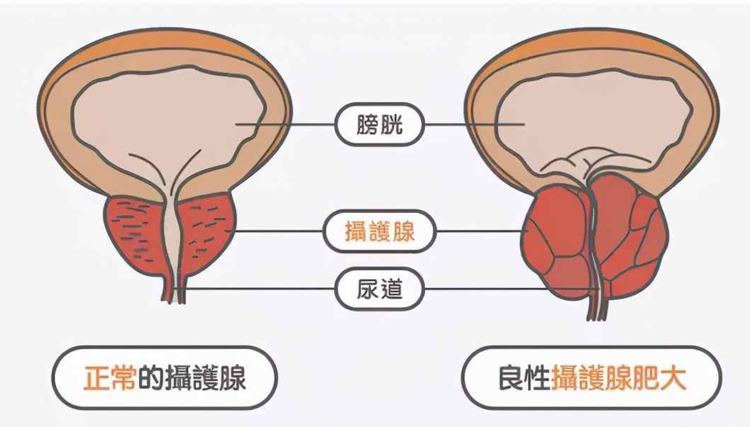 1701946229507625.png 攝護腺肥大.png